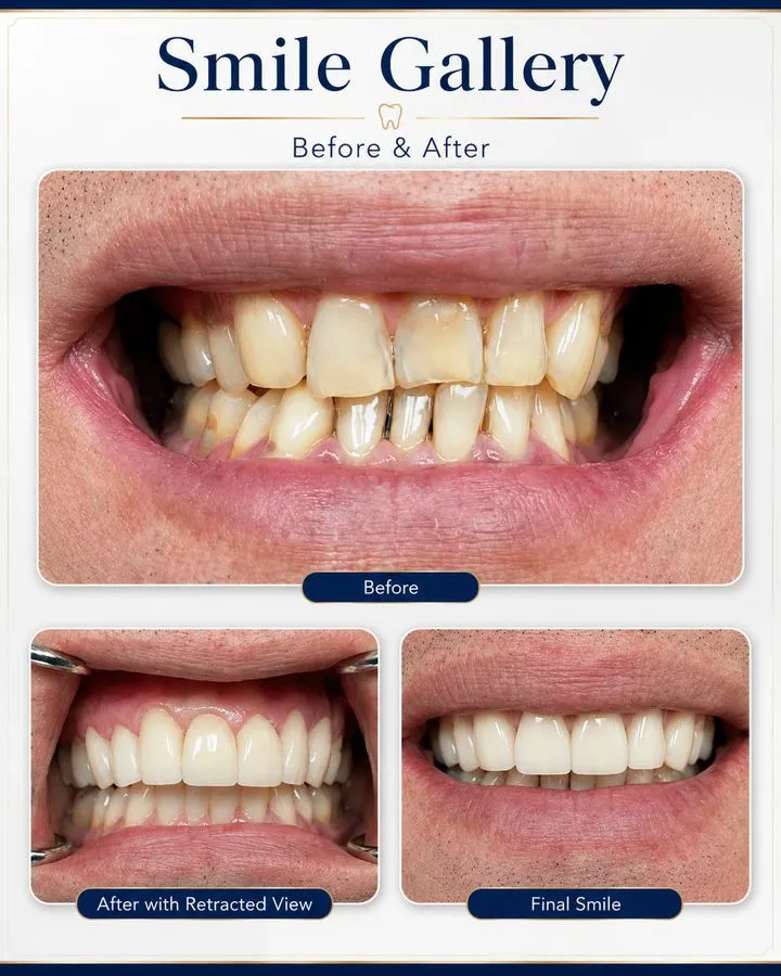 Before and after: Smile Restoration — SoftDental Houston, real patient case with signed consent