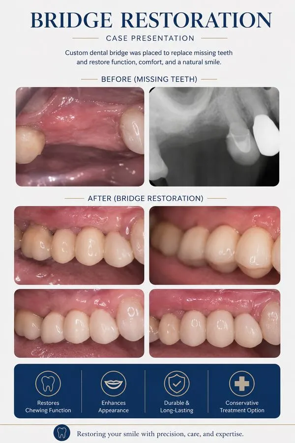 Before and after: Bridge Restoration — SoftDental Houston, real patient case with signed consent