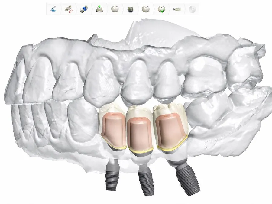 Anatomage software showing 3D virtual implant planning at SoftDental Houston